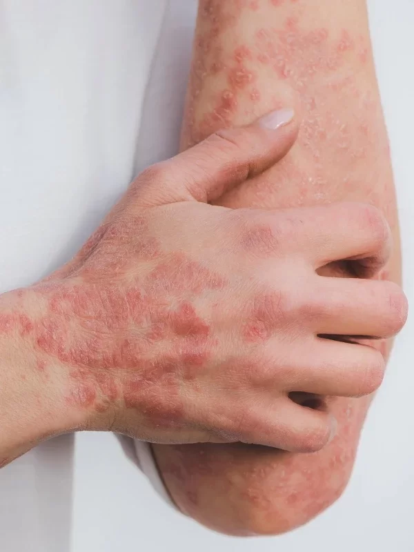 Magn&eacute;tisme ecz&eacute;ma &agrave; Marseille